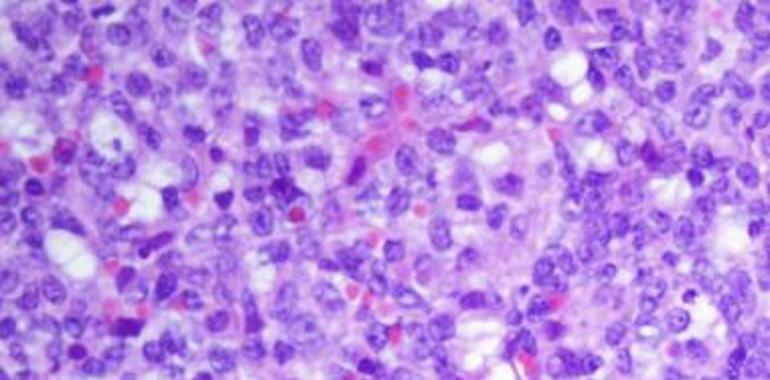 El genoma de la leucemia abre sus células