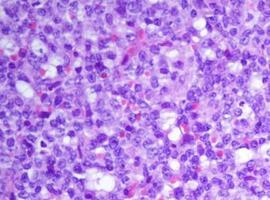 El genoma de la leucemia abre sus células