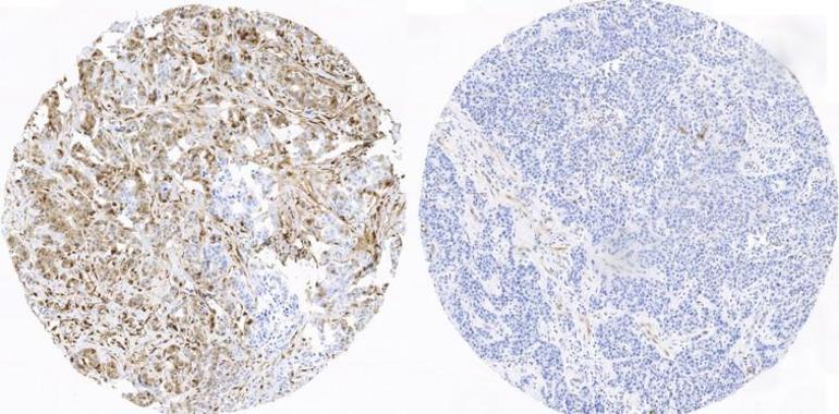 Nuevo hallazo decisivo para análisis de quinasas en el cáncer de mama