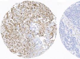 Nuevo hallazo decisivo para análisis de quinasas en el cáncer de mama
