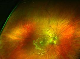 Un dispositivo  permite medir con gran precisión la sensibilidad retiniana