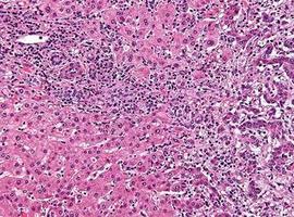 Identifican dos subtipos del cáncer hepático más agresivo 