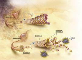 Una nueva terapia retrasa la evolución del Alzhéimer