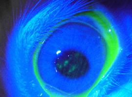 El papel de IL-6 en procesos inflamatorios de la superficie ocular