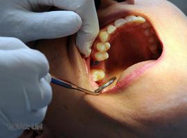 El exceso de zinc en los adhesivos para empastes dentales reduce su eficacia