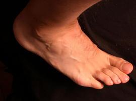 Nanomedicina para las úlceras del pie diabético