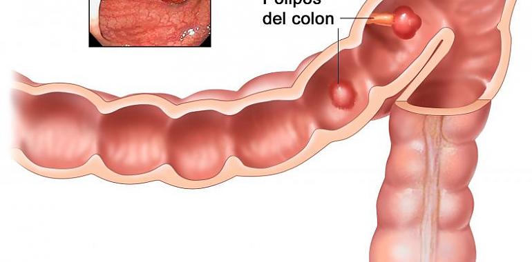 Asturias salva vidas con la detección precoz del cáncer de colon: 633 carcinomas y 5.907 lesiones precancerosas detectadas