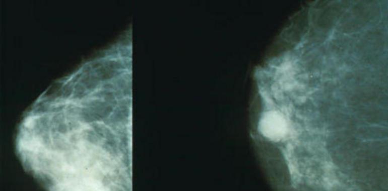 La mejora en el cribado del cáncer de mama aumenta la eficacia de la diagnosis
