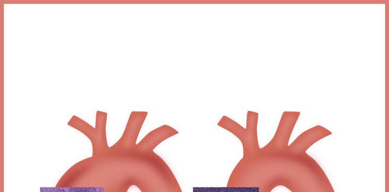 Descubren la causa de la rigidez de la aorta en el #síndrome de #Marfan