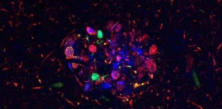 Características de la enfermedad de Alzheimer varían según el paciente
