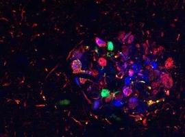 Características de la enfermedad de Alzheimer varían según el paciente