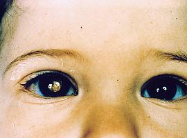Un fármaco biológico mejora el tratamiento de cáncer de retina en niños