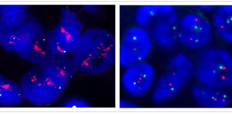 El IMOM de Asturias se pone a la vanguardia internacional del tratamiento del cáncer 