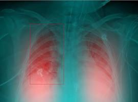 Inteligencia artificial para identificar neumonías de pacientes de Covid-19 