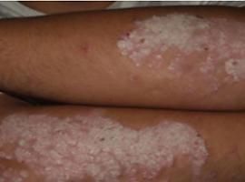 El 73% de los pacientes con psoriasis en Asturias no están satisfechos con su tratamiento 