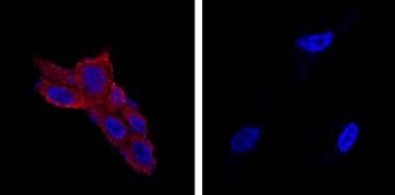 Nuevo tratamiento del cáncer de próstata destruye las tumorales con nanomedicina orgánica