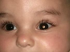 Tratan por primera vez en el mundo un retinoblastoma pediátrico con un virus oncolítico