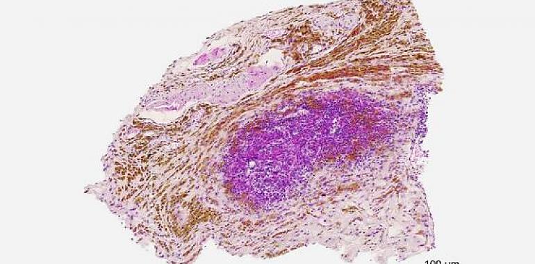 Un nuevo tratamiento contra el cáncer de páncreas estimula las defensas y frena el crecimiento tumoral