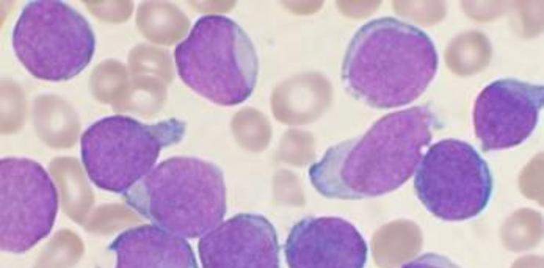 Describen una nueva mutación implicada en un tipo de leucemia infantil