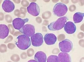 Describen una nueva mutación implicada en un tipo de leucemia infantil