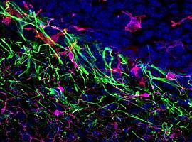 Metástasis: el peligroso viaje del cáncer hacia otros órganos y tejidos