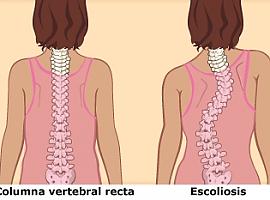 Asturias introduce la tecnología digital y la impresión 3D en un tratamiento innovador contra la escoliosis idiopática