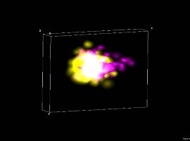 Las proteínas tóxicas se propagan por el cerebro en las personas con Alzheimer