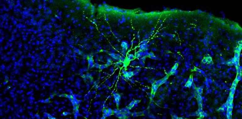 Los tumores cerebrales ‘hackean’ la comunicación entre las neuronas