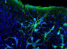 Los tumores cerebrales ‘hackean’ la comunicación entre las neuronas