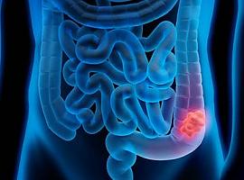Descubierto un nuevo mecanismo en cáncer colorrectal que controla la migración e invasión celular