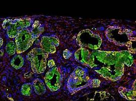 Descubierta una nueva diana terapéutica para combatir el cáncer de páncreas