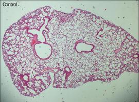 Un fármaco antitumoral previene el desarrollo de la fibrosis pulmonar 