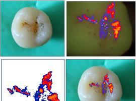 Nuevas tecnologías para el diagnóstico temprano de caries