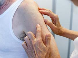 El 85% de los pacientes diagnosticados con melanoma maligno supera este tipo de cáncer de piel 