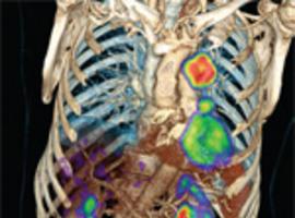 Comienzan los ensayos clínicos con pacientes en el PET/CT del CNA