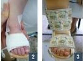 La aplicación precoz de fisioterapia en bebés con ‘pie zambo’ evita la cirugía hasta en un 70% de casos 