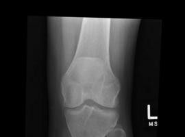 Tratar las fracturas óseas con genéricos dobla la vida de las prótesis de cadera y rodilla