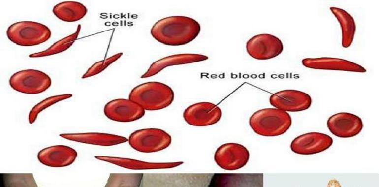 Pre-natal diagnosis for sickle cell disease safe procedure for mother & child