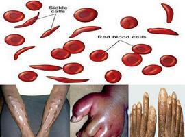 Pre-natal diagnosis for sickle cell disease safe procedure for mother & child