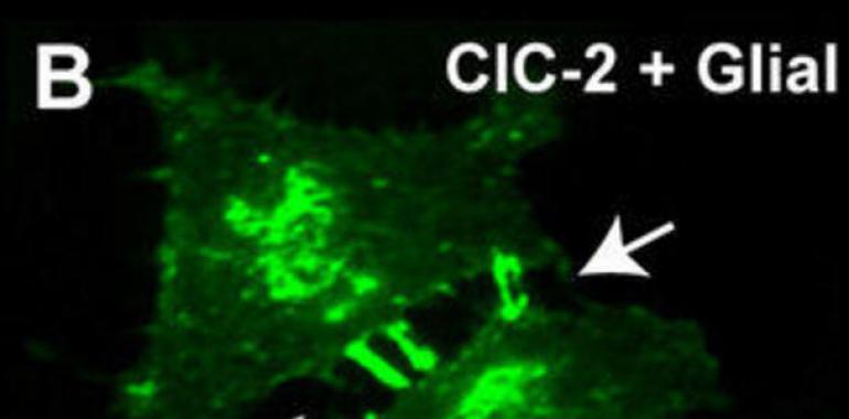 Identificadan la función de un gen involucrado en la formación de edemas en el cerebro