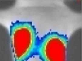 Una proteína predice el riesgo de metástasis pulmonar en pacientes con cáncer de mama