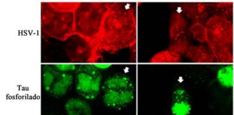 Nuevas evidencias relacionan el virus del herpes simple con el alzhéimer