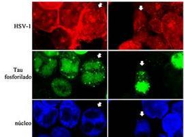 Nuevas evidencias relacionan el virus del herpes simple con el alzhéimer