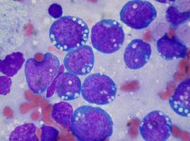 Limitan la capacidad tumoral de las células en el linfoma de Burkitt 