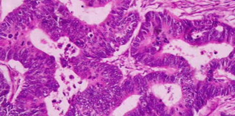 El silencio del gen USP9X acelera el cáncer de páncreas 