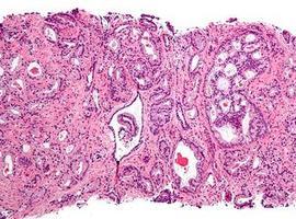 Investigadores españoles identifican un mecanismo para atacar las células madre del cáncer de próstata