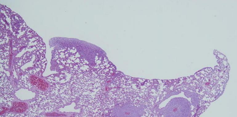 Descubierta una ruta clave en la metástasis del cáncer de mama en pulmón