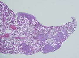 Descubierta una ruta clave en la metástasis del cáncer de mama en pulmón