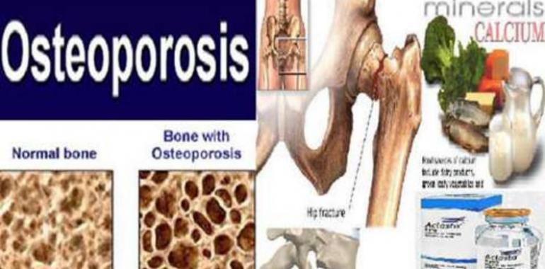 50 per cent of Indian population to be victim of Osteoporosis by next decade