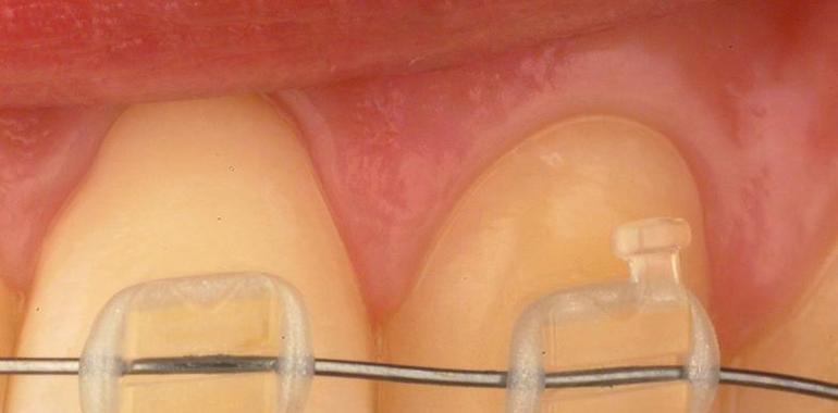 Nanopartículas para reforzar los brackets transparentes de las ortodoncias